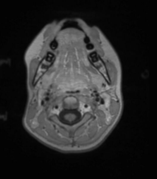 File:Choroid plexus carcinoma (Radiopaedia 91013-108553 Axial T1 C+ 36).jpg