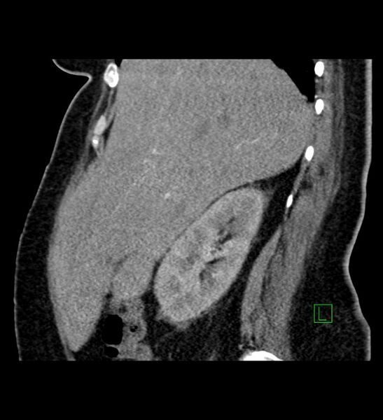 File:Chromophobe renal cell carcinoma (Radiopaedia 84239-99519 D 85).jpg