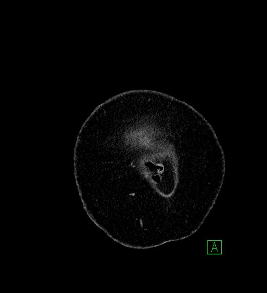 File:Chromophobe renal cell carcinoma (Radiopaedia 84239-99519 F 1).jpg