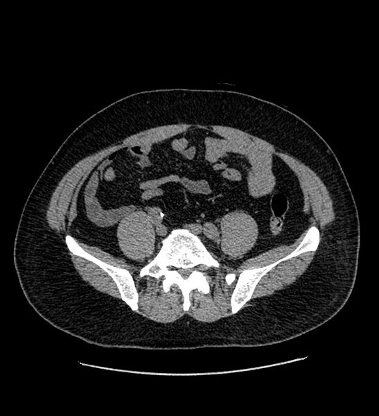 File:Chromophobe renal cell carcinoma (Radiopaedia 84337-99693 Axial non-contrast 108).jpg