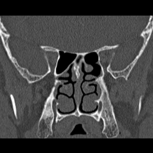 File:Chronic maxillary sinusitis (Radiopaedia 27879-28116 Coronal bone window 37).jpg