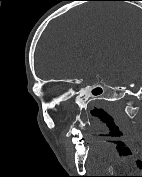 File:Chronic maxillary sinusitis caused by a foreign body (Radiopaedia 58521-65676 Sagittal bone window 57).jpg