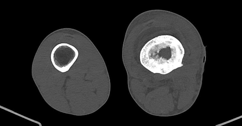 File:Chronic osteomyelitis (with sequestrum) (Radiopaedia 74813-85822 Axial non-contrast 151).jpg