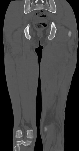 File:Chronic osteomyelitis (with sequestrum) (Radiopaedia 74813-85822 Coronal non-contrast 40).jpg