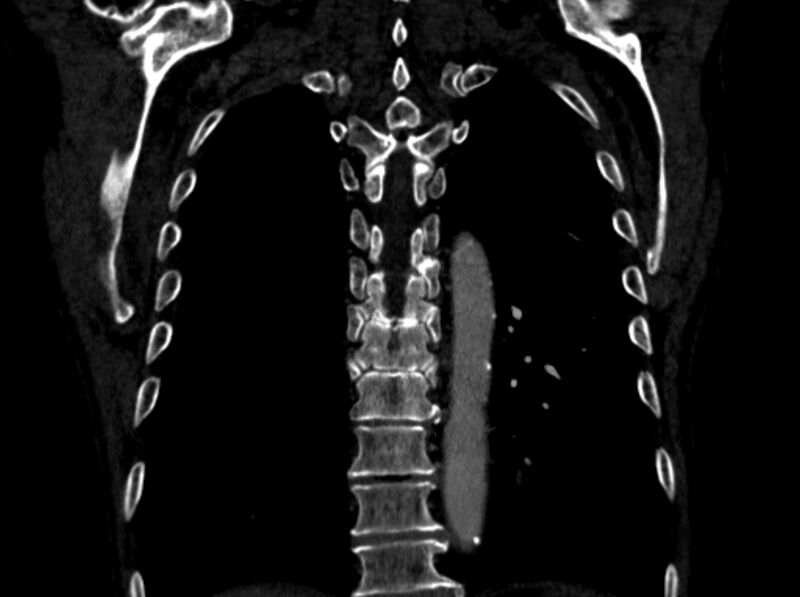 File:Chronic pulmonary embolism (Radiopaedia 91241-108843 A 89).jpg