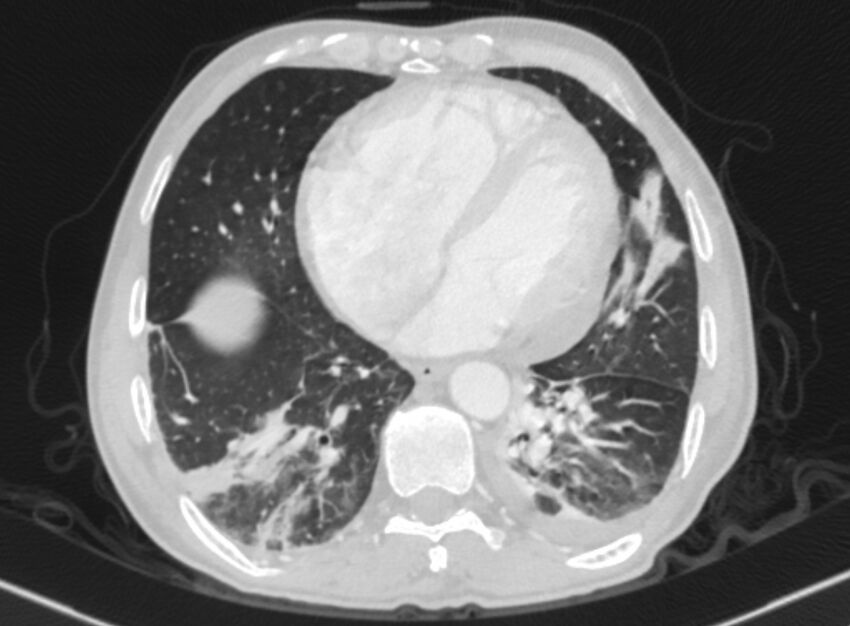 Chronic pulmonary embolism with bubbly consolidation (Radiopaedia 91248-108850 Axial lung window 112).jpg