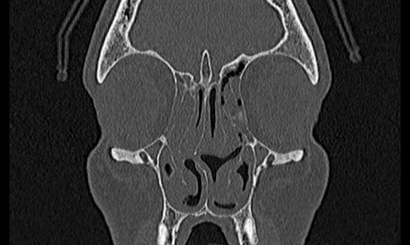 File:Chronic rhinosinusitis (Radiopaedia 65079-74075 Coronal bone window 22).jpg