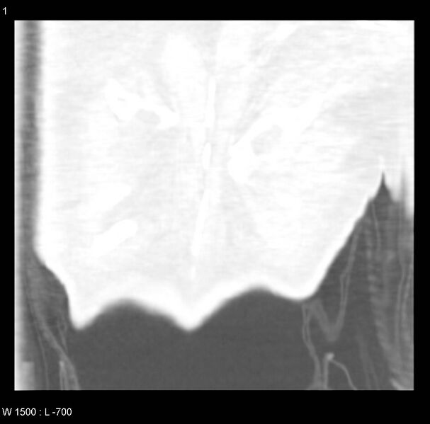 File:Clagett thoracotomy (Radiopaedia 8568-9403 Coronal lung window 1).jpg