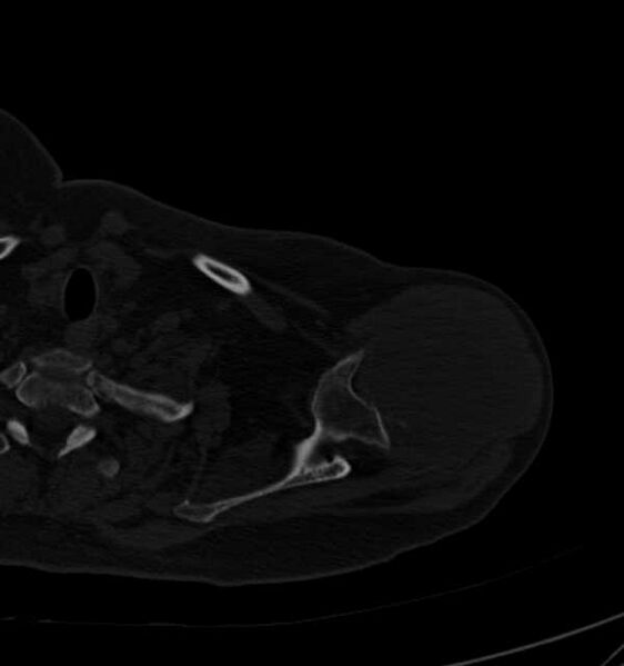 File:Clear cell chondrosarcoma - humerus (Radiopaedia 63104-71612 Axial bone window 25).jpg