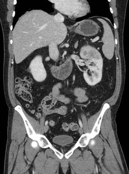 File:Clear cell renal cell carcinoma (Radiopaedia 61449-69393 F 14).jpg