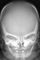 Cleidocranial dysostosis (Radiopaedia 11319-11683 B 1).jpg