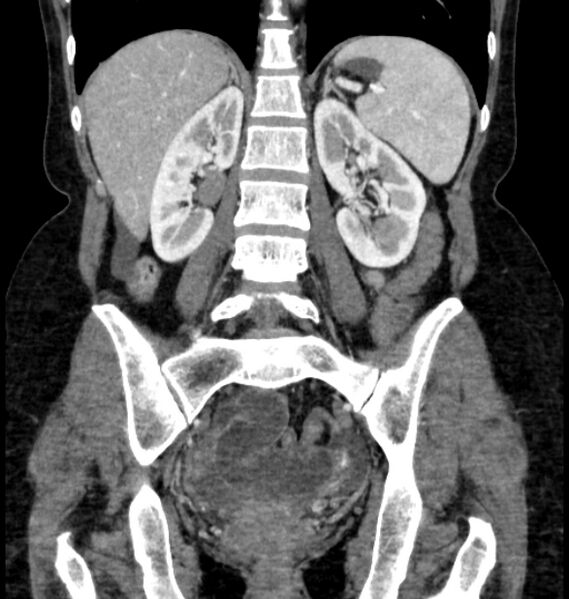 File:Closed loop small bowel obstruction (Radiopaedia 71211-81508 B 84).jpg