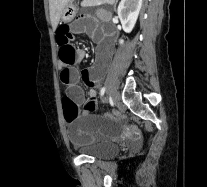 File:Closed loop small bowel obstruction (Radiopaedia 71211-81508 C 102).jpg
