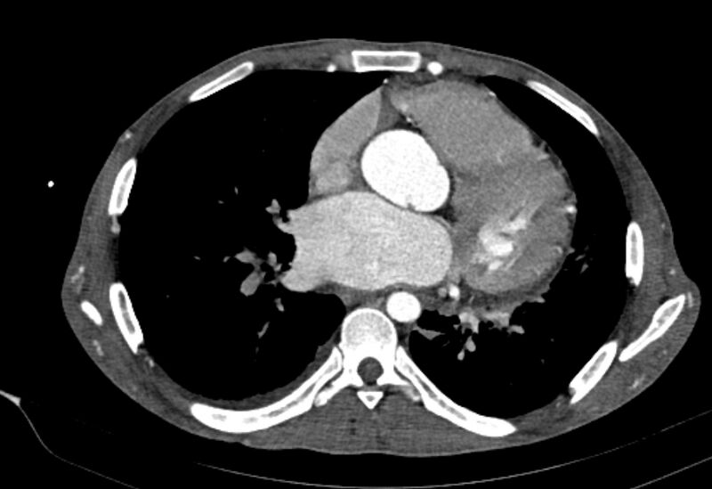 File:Coarctation of aorta with aortic valve stenosis (Radiopaedia 70463-80574 A 116).jpg