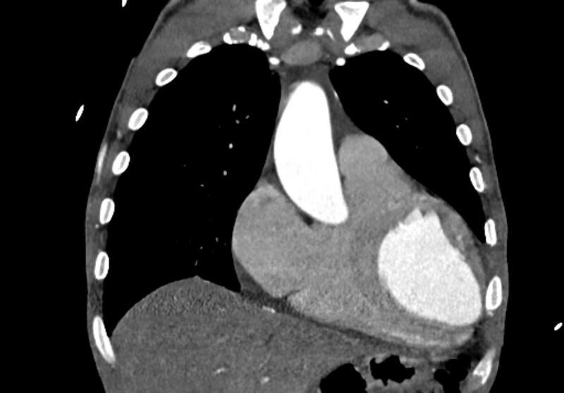 File:Coarctation of aorta with aortic valve stenosis (Radiopaedia 70463-80574 C 56).jpg