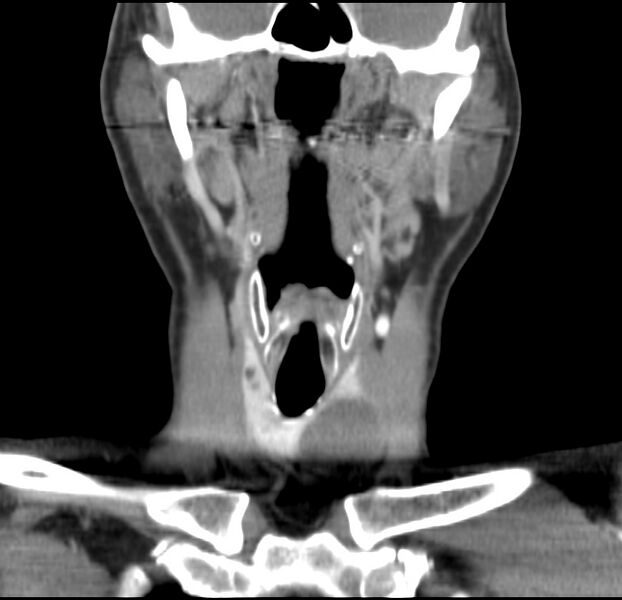File:Colloid cyst of thyroid (Radiopaedia 22897-22923 Coronal C+ delayed 27).jpg