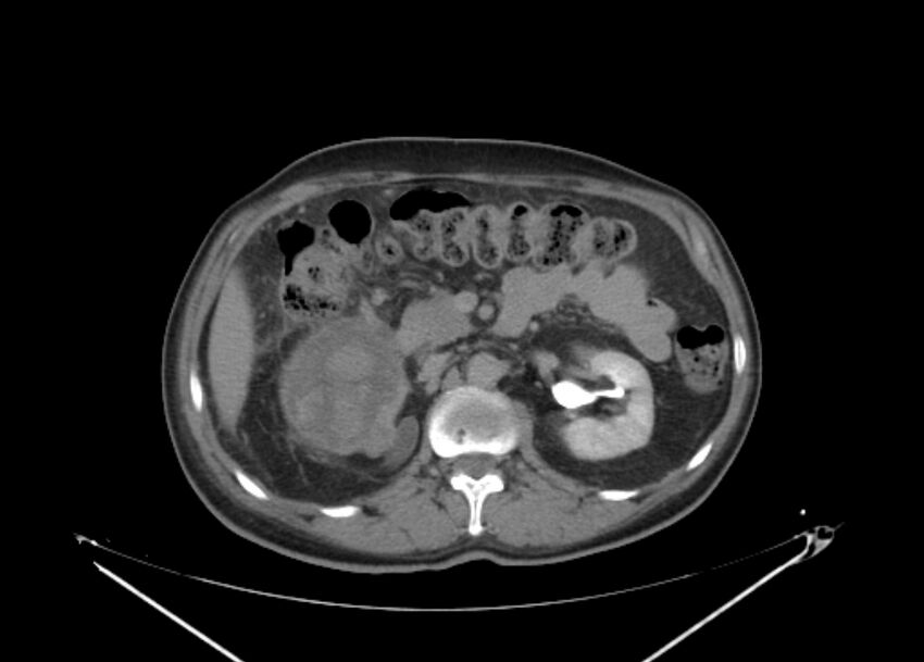 Colon cancer mimicking renal cell carcinoma (Radiopaedia 28986-29335 Axial C+ delayed 29).jpg