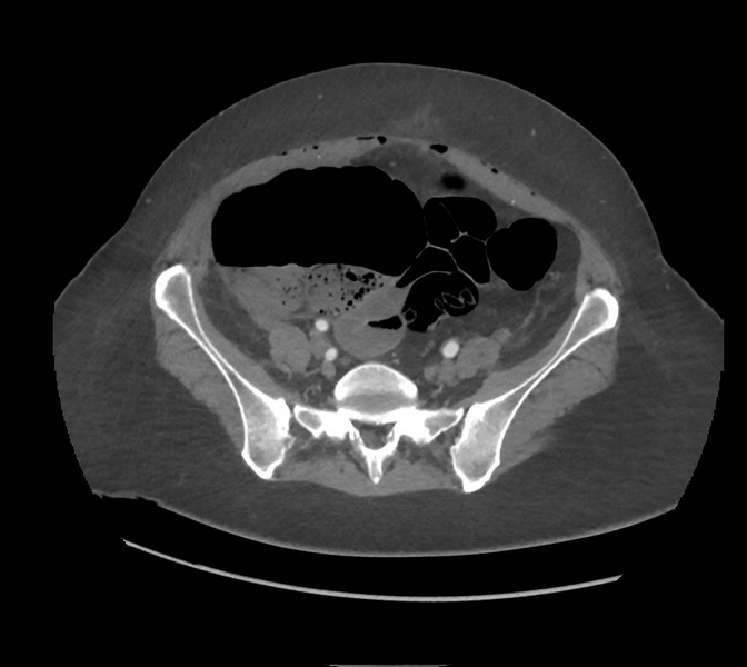 File:Colonic pseudo-obstruction (Radiopaedia 79752-92980 A 138).png