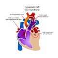 Hypoplastic left heart syndrome (creative commons) (Radiopaedia 73323).png