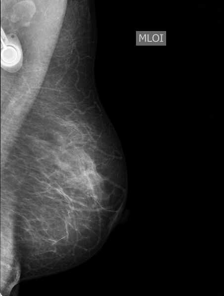 File:Implantable port-a-catheter (on mammography) (Radiopaedia 77491).jpg