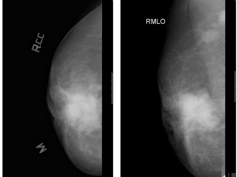 File:Locally advanced breast cancer (Radiopaedia 5758).jpg
