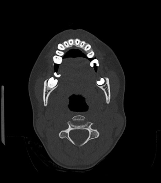 File:Nasoorbitoethmoid fracture (Radiopaedia 90044-107205 Axial bone window 40).jpg