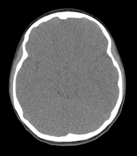 File:Nasoorbitoethmoid fracture (Radiopaedia 90044-107205 Axial non-contrast 196).jpg