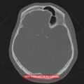 Nasopharyngeal carcinoma recurrence - skull base destruction (Radiopaedia 29107-29490 Axial bone window 63).jpg