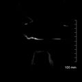 Neonatal neuroblastoma (Radiopaedia 56651-63438 Coronal non-contrast 53).jpg