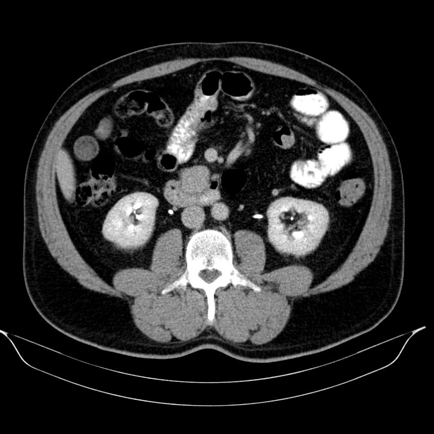 Neuroendocrine tumor of head of pancreas (Radiopaedia 57538-64502 D 43).jpg