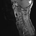 Neurofibromatosis type 1 (Radiopaedia 80355-93740 G 2).jpg