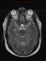 Neuroglial cyst (Radiopaedia 10713-11184 Axial T2 15).jpg