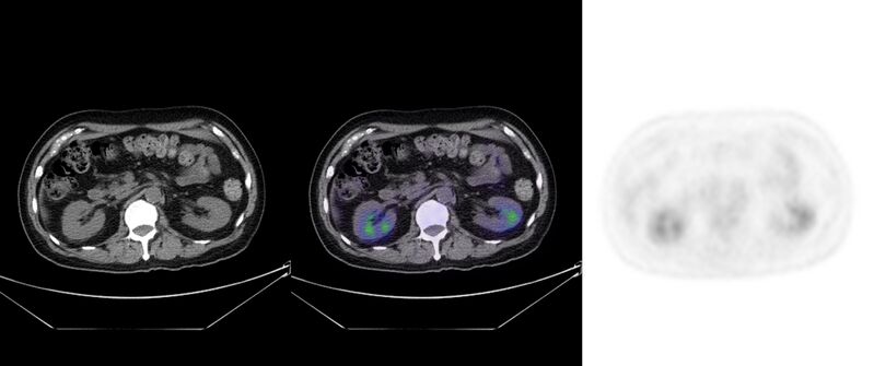 File:Non-Hodgkin lymphoma involving seminal vesicles with development of interstitial pneumonitis during Rituximab therapy (Radiopaedia 32703-33752 ax CT Fus PET 38).jpg