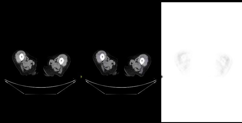 File:Non-Hodgkin lymphoma involving seminal vesicles with development of interstitial pneumonitis during Rituximab therapy (Radiopaedia 32703-33761 ax CT Fus PET 67).jpg