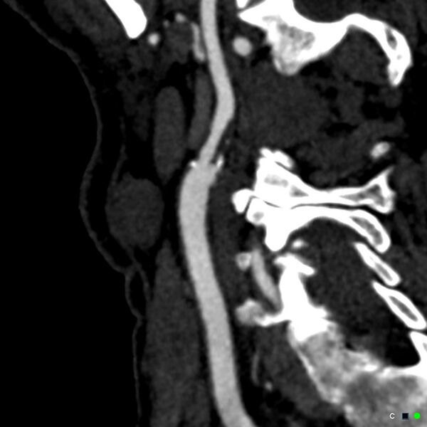 File:Non-occlusive intraluminal internal carotid artery thrombus (Radiopaedia 37751-39658 C 46).jpg