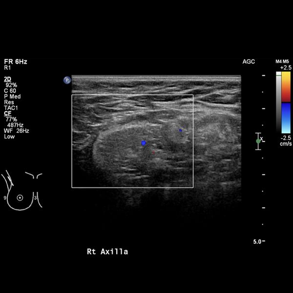 File:Normal breast mammography (tomosynthesis) and ultrasound (Radiopaedia 65325-74354 Right breast 17).jpeg