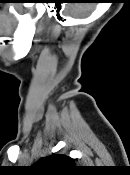 File:Normal cervical spine MRI (including Dixon) (Radiopaedia 42762-45926 C 2).png