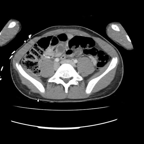 File:Normal dual-phase trauma CT chest,abdomen and pelvis (Radiopaedia 48092-52899 A 86).jpg