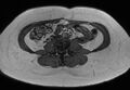 Normal liver MRI with Gadolinium (Radiopaedia 58913-66163 B 1).jpg