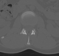 Normal lumbar spine CT (Radiopaedia 46533-50986 Axial bone window 18).png