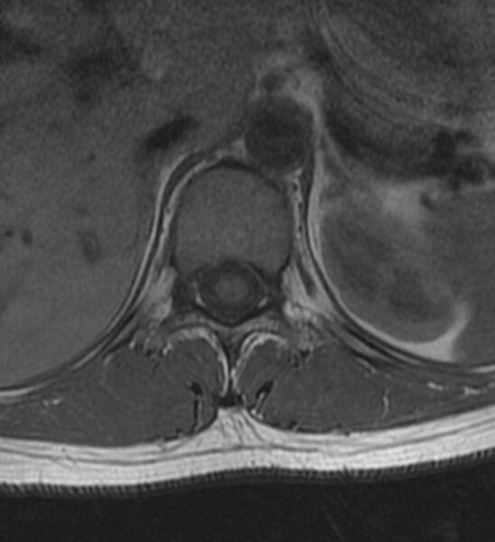 File:Normal thoracic spine MRI (Radiopaedia 41033-43781 Axial T1 23).jpg