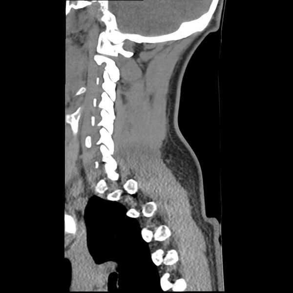 File:Normal trauma spine imaging (Radiopaedia 31753-32686 A 10).jpg