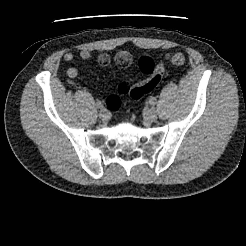 Obstructing ureteric calculus and ureteric anatomy (Radiopaedia 62730-71042 Axial non-contrast 123).jpg