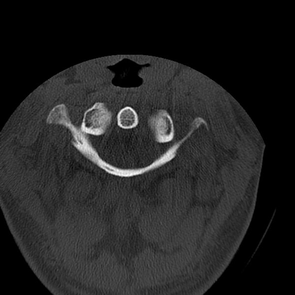 File:Occipital condyle fracture (Radiopaedia 31755-32691 Axial bone window 15).jpg