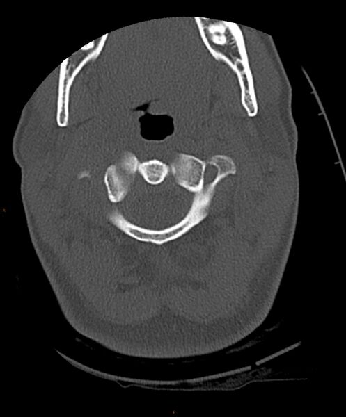 File:Occipital condyle fracture (Radiopaedia 61165-69056 D 10).jpg