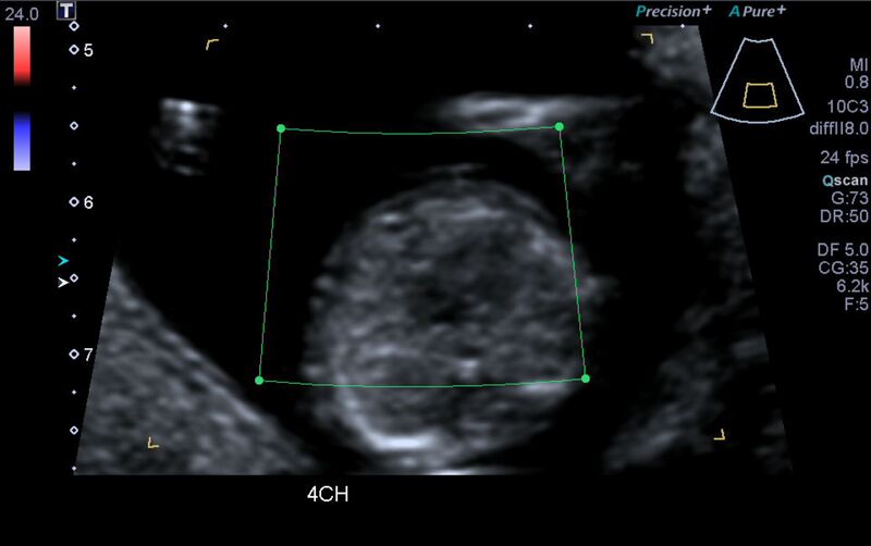 File:1st trimester nuchal-morphology ultrasound (Radiopaedia 44706-48477 Heart views cine with colour 35).jpg