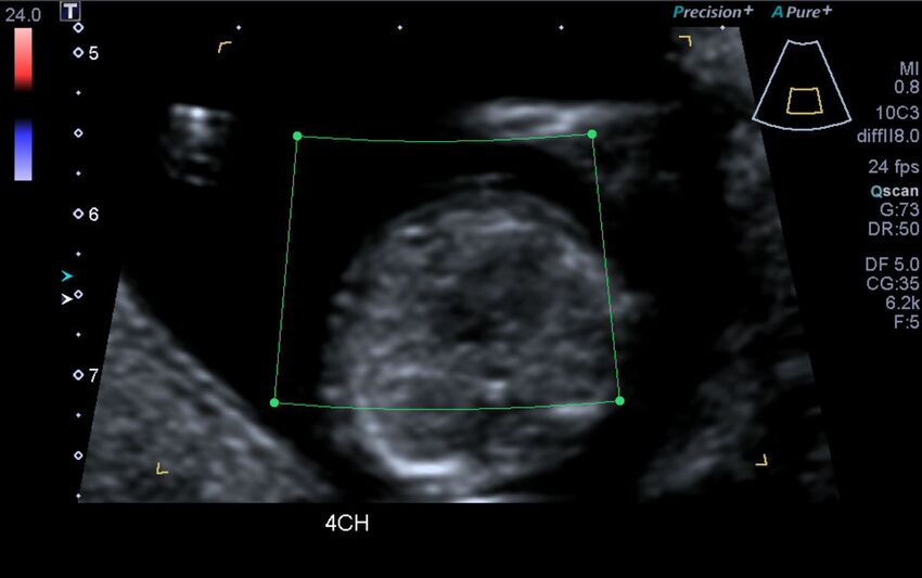 1st trimester nuchal-morphology ultrasound (Radiopaedia 44706-48477 Heart views cine with colour 35).jpg