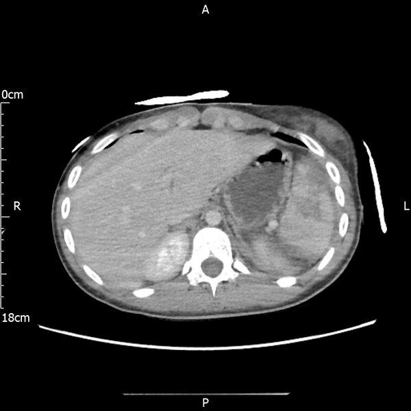 File:AAST grade IV kidney injury with CEUS follow-up (Radiopaedia 72353-82877 Axial C+ portal venous phase 13).jpg