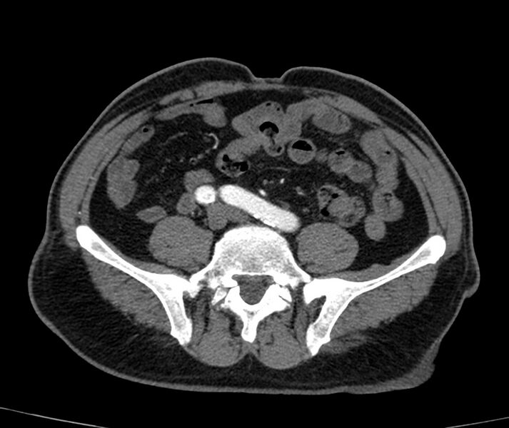 File:Abdominal aortic aneurysm (Radiopaedia 22421-22458 C+ arterial phase 64).jpg