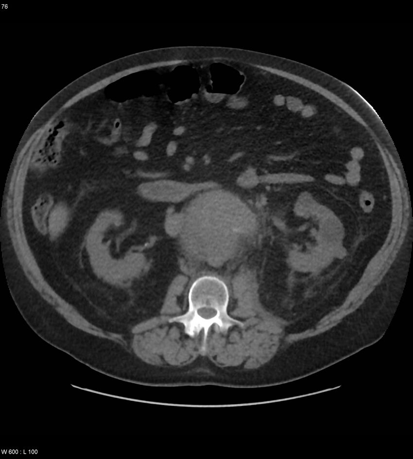 Abdominal aortic aneurysm with intramural hematoma then rupture (Radiopaedia 50278-55631 Axial non-contrast 72).jpg